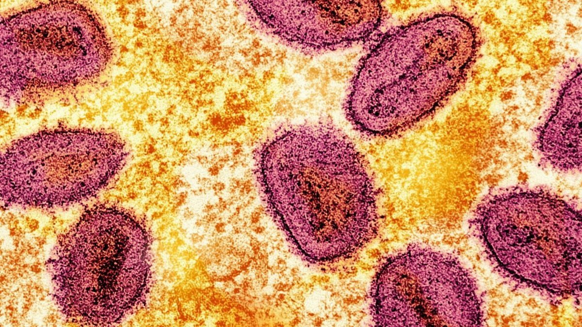 First case of deadly form of poxvirus found in UK – MIDOR – EAST OKU LATEST